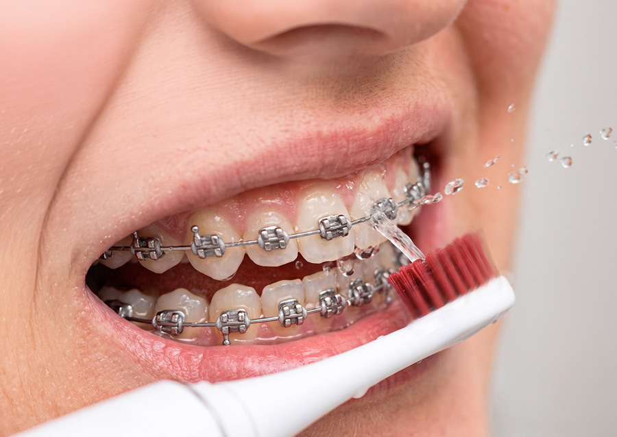Limpieza ideal para brakets, implantes o encías sensibles